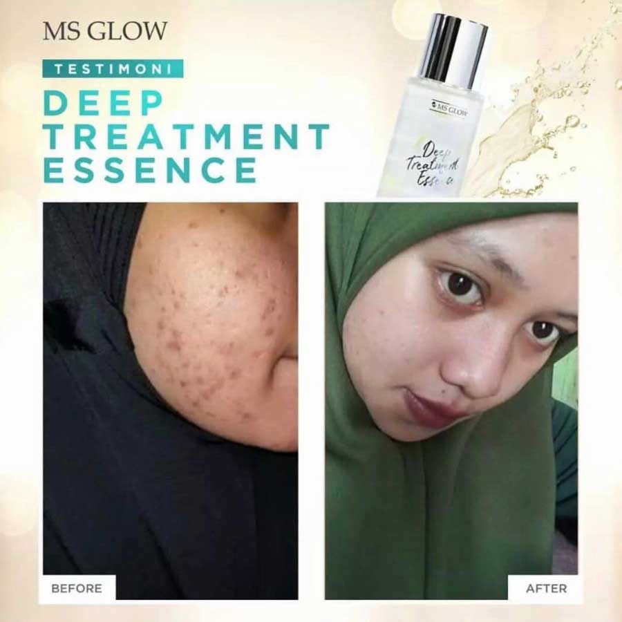 MS Glow Deep Treatment Essence Skin Barrier - 3